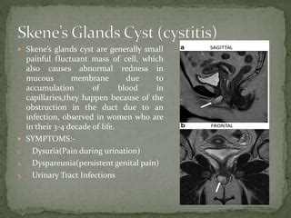 glande skene|Skene’s Gland Cyst: Causes, Symptoms & Treatment